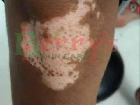 After Vitiligo treatment result